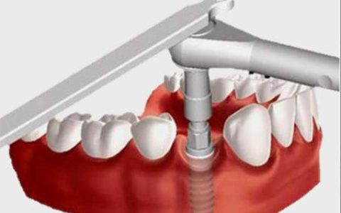 种植牙多少钱一颗2022价格表