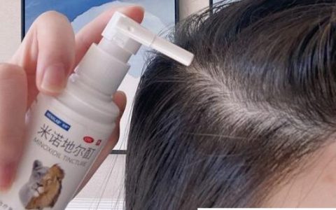 米诺地尔酊真的可以生发吗 效果十分显著